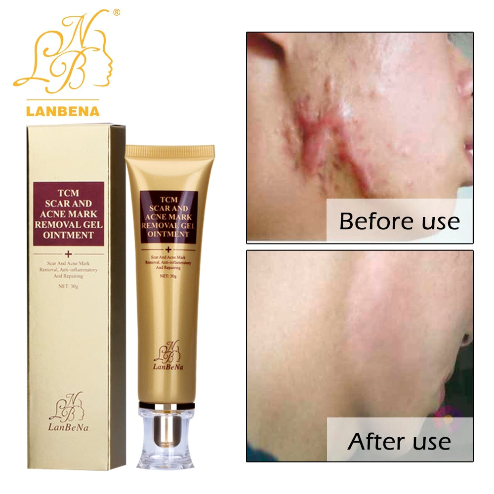 LANBENA Acne Scar Removal Cream Skin Repair Face Cream Acne Spots Treatment Anti Aging Acne Cream Blackhead Whitening Day Cream